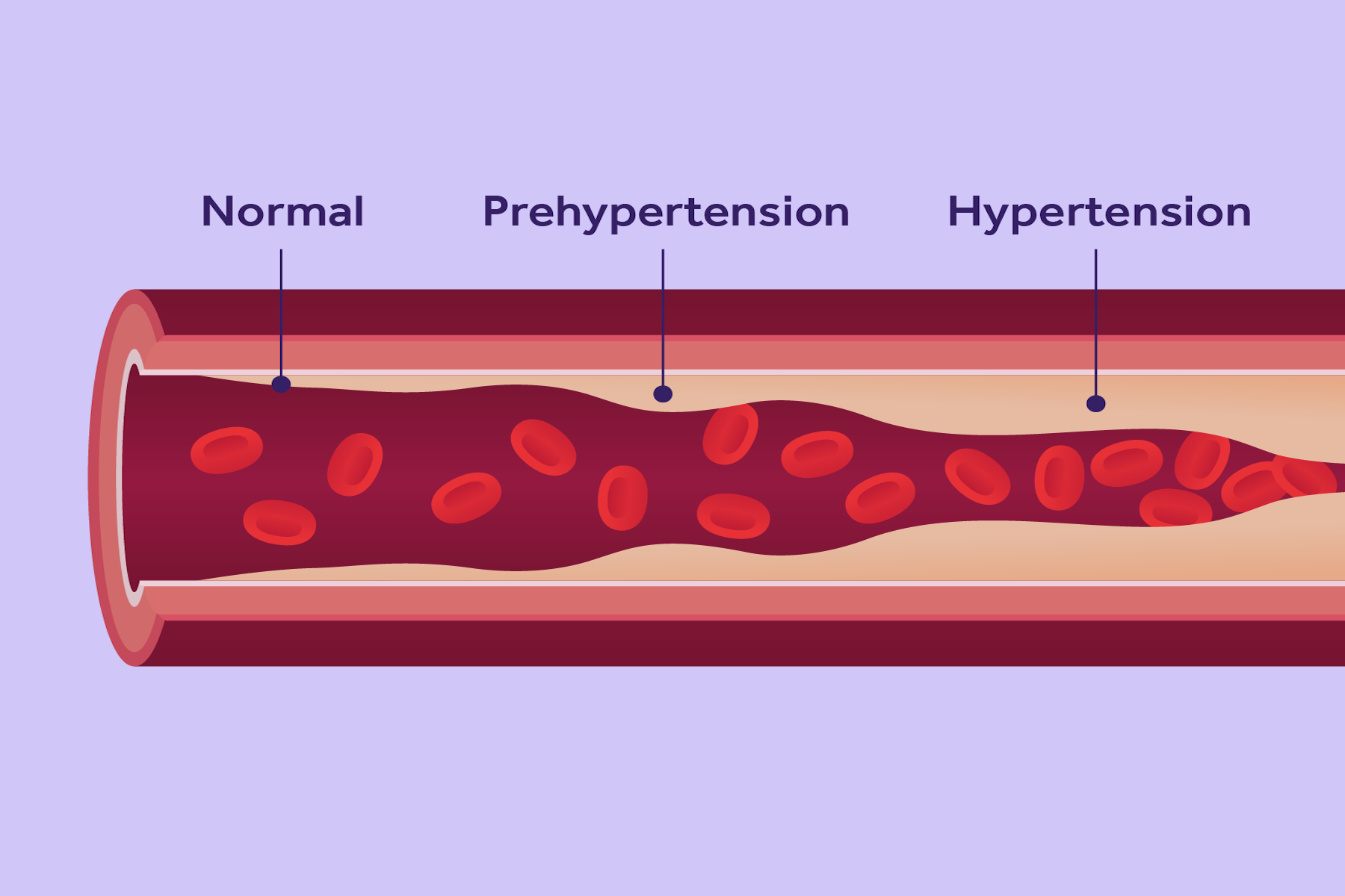 High Blood Pressure Doctor in McAllen